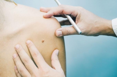 Cáncer de piel: una realidad a la que pocas personas le prestan atención